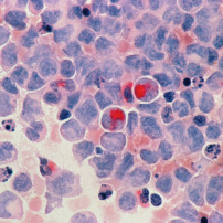 Femme soudanaise cancer