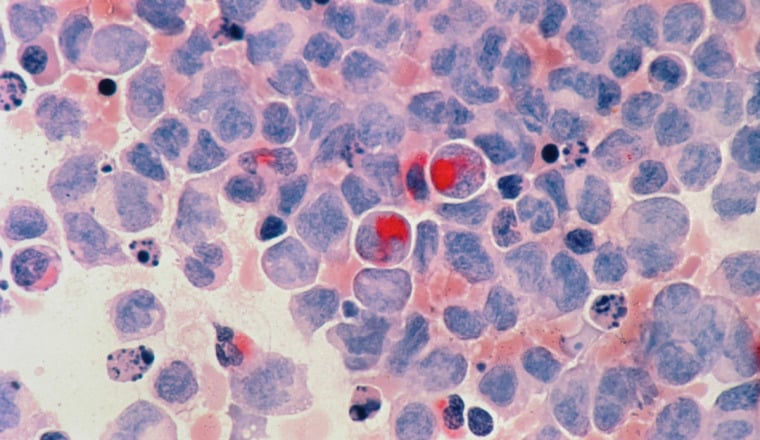 Femme soudanaise cancer
